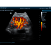 Mindray Z6 Portable Colour Doppler Ultrasound