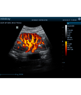 Mindray Z6 Portable Colour Doppler Ultrasound