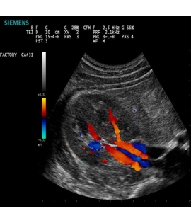 Siemens Acuson P300 Ultrasound